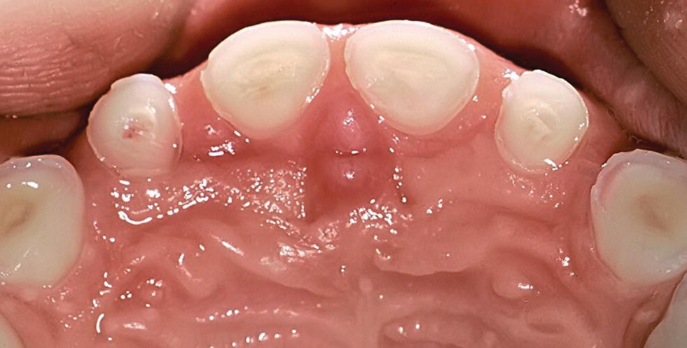 13 Dental Erosion Pocket Dentistry