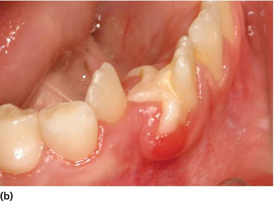 14 Periodontal Conditions Pocket Dentistry