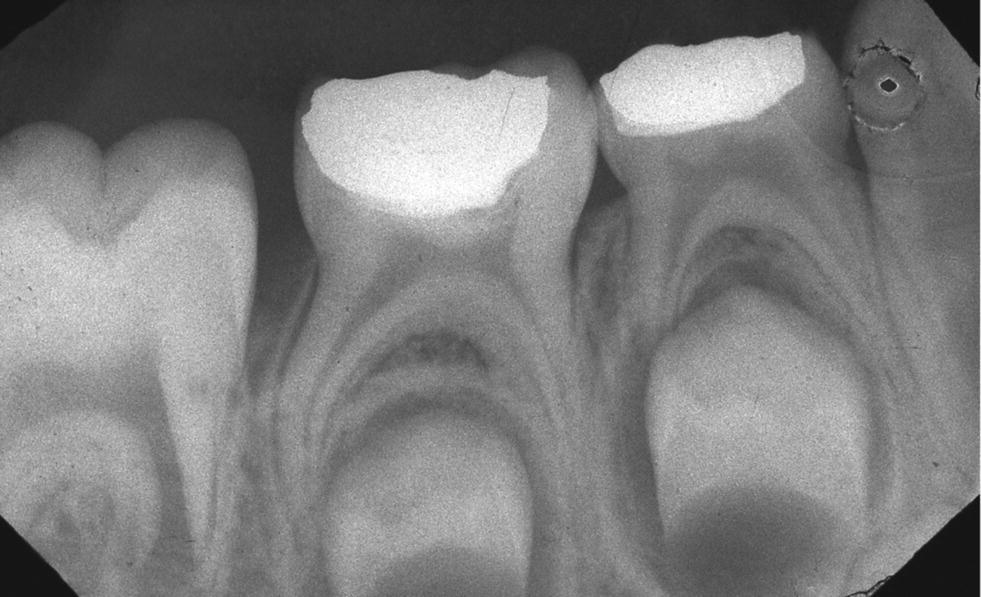 16 Endodontic Management of Primary Teeth Pocket Dentistry