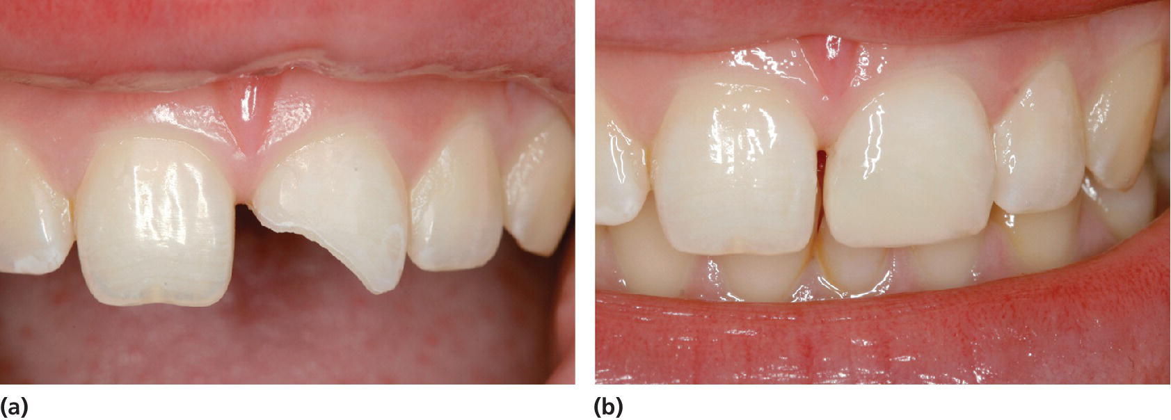 18 Traumatic Dental Injuries Pocket Dentistry