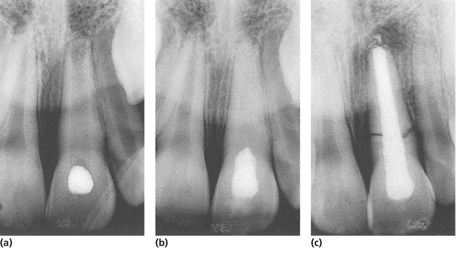 19 Traumatic Dental Injuries Pocket Dentistry