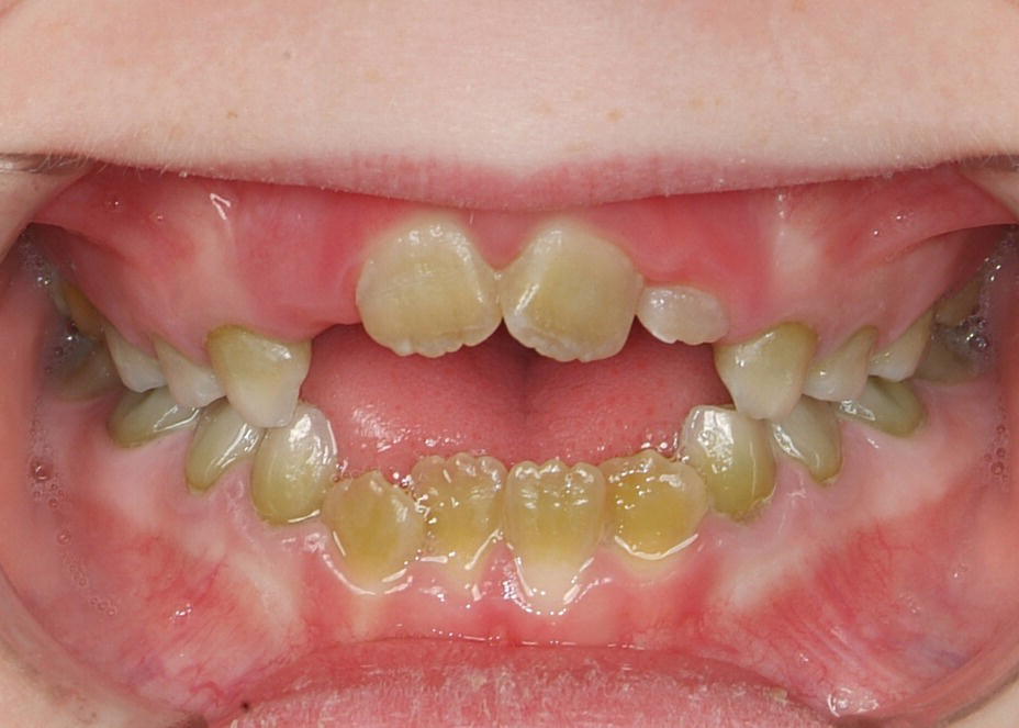 20 Developmental Defects of the Dental Hard Tissues and