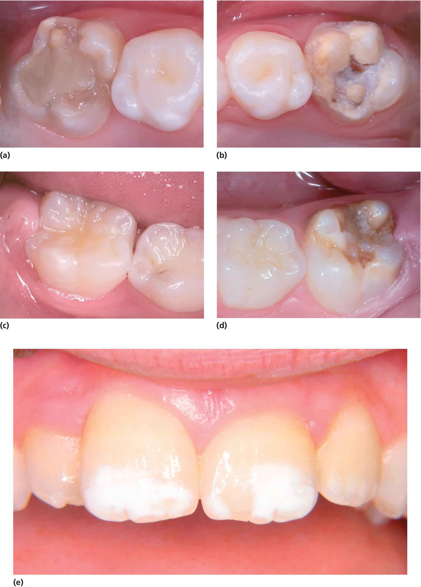 20 Developmental Defects of the Dental Hard Tissues and their