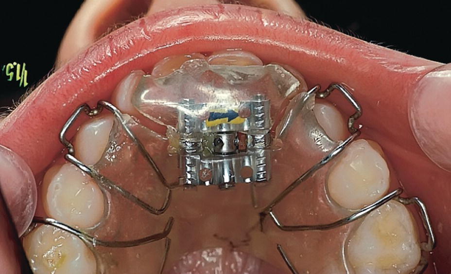 21 Occlusal Development, Malocclusions, and Preventive and