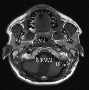 Comparison of the effect of the rotation palatoplasty and V–Y pushback ...