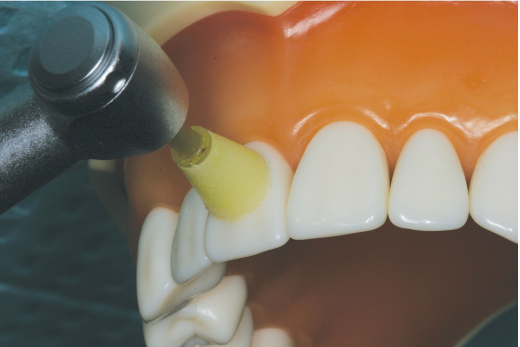 Composite Finishing and Polishing Pocket Dentistry