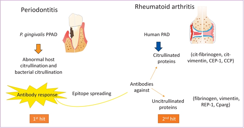 Periodontitis Linked to Increased Risk of Rheumatoid Arthritis, Study Finds