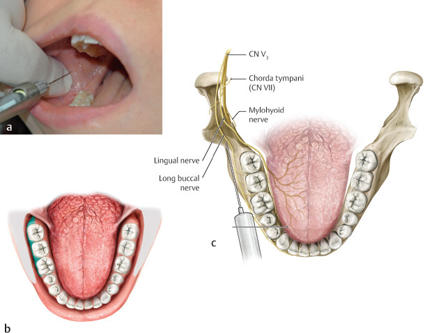 4 Anatomy Of Local Anesthesia For Dentistry Chapter Reproduced From 