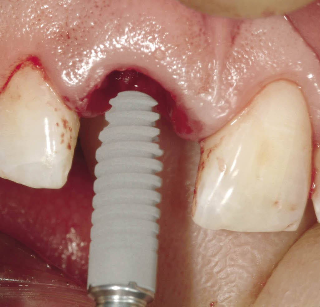 7 Immediate Placement and Computerguided Surgery Pocket Dentistry