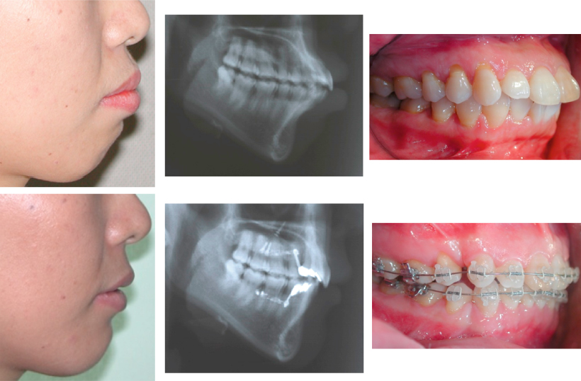 Protruding Upper Lip Braces