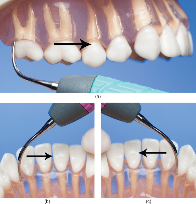 7 Ultrasonic instrumentation technique modules Pocket Dentistry