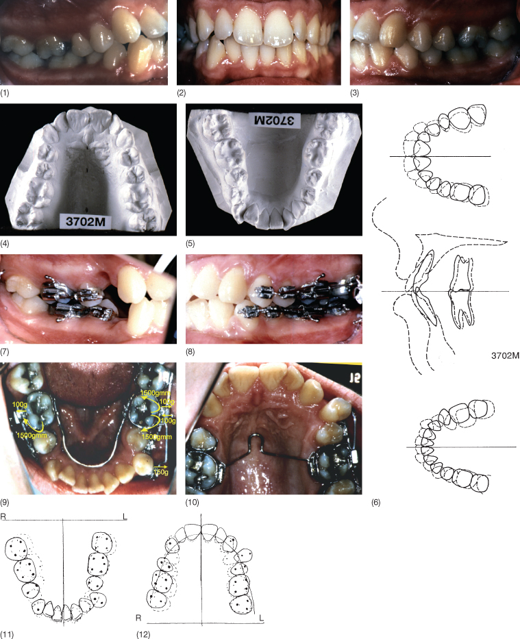 8 Anchorage Problems Pocket Dentistry