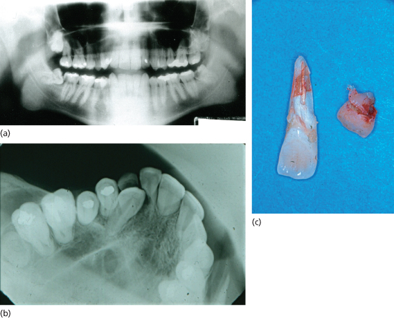 9 Extraction of Unerupted or Partly Erupted Teeth Pocket Dentistry