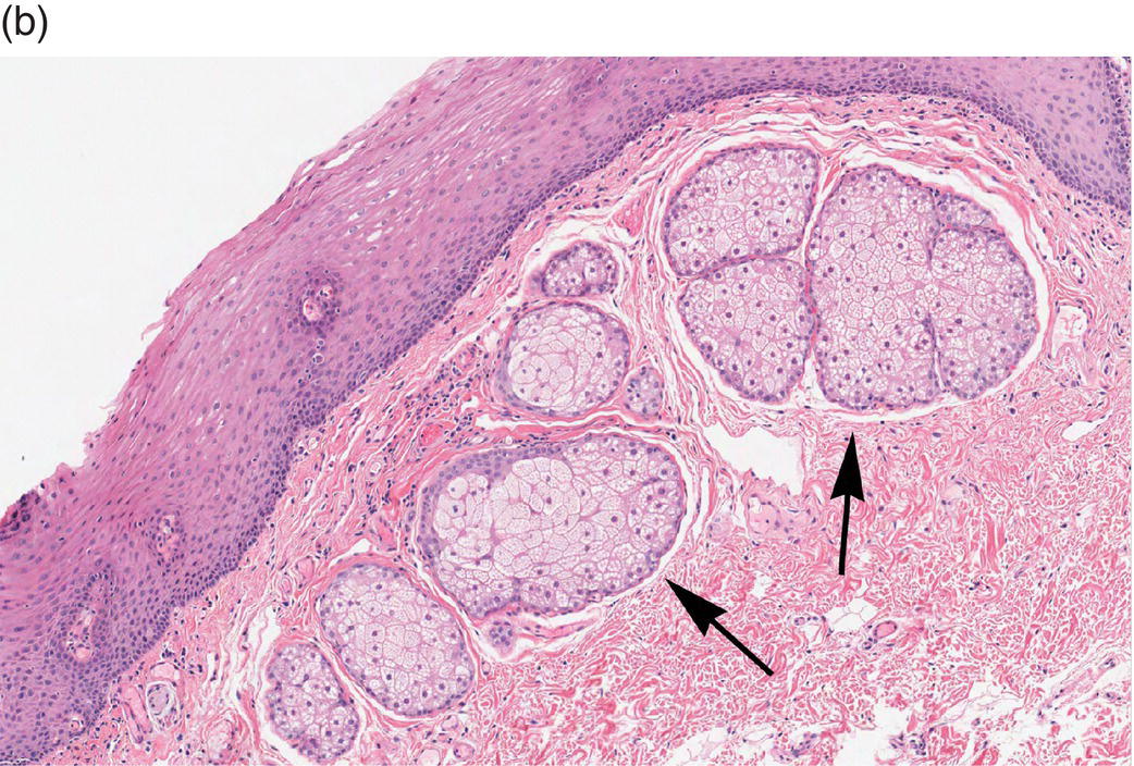 9 Oral Mucosa and Mucosal Sensation Pocket Dentistry