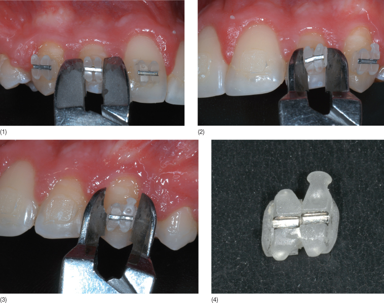 9 Bonding Problems Related to Adult Rehabilitated Dentitions Pocket