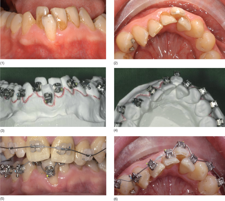 12 A Systematic Approach to the Orthodontic Treatment of Periodontally Involved Anterior Teeth