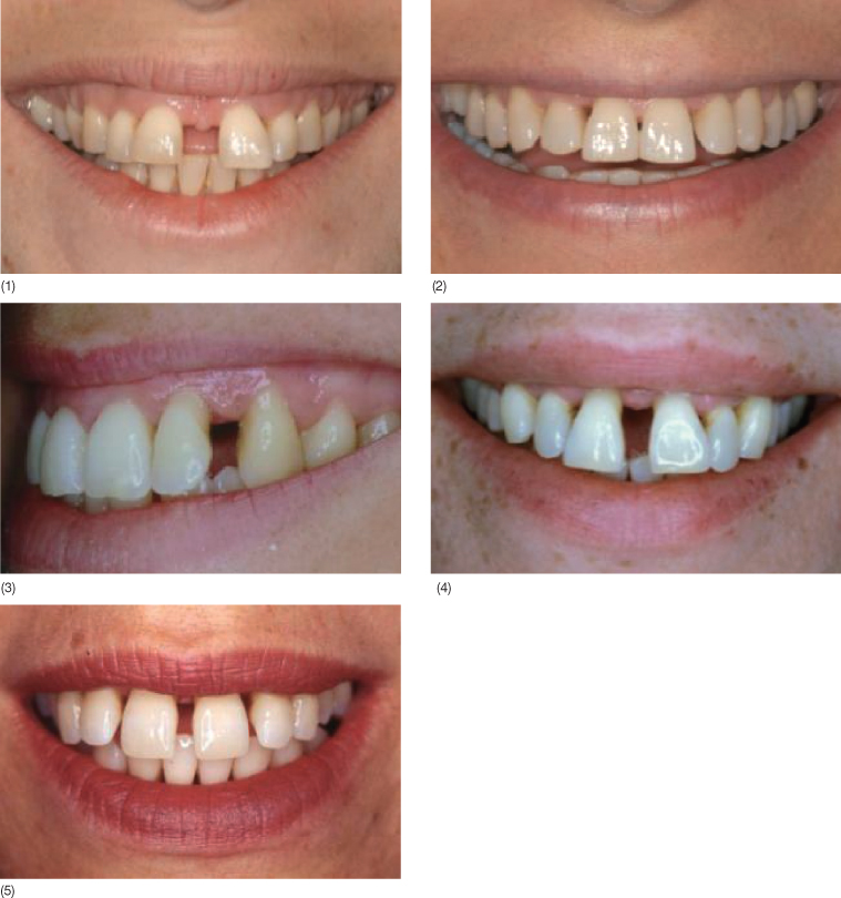 12 A Systematic Approach to the Orthodontic Treatment of Periodontally