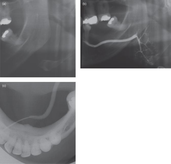 13 Imaging of the salivary glands Pocket Dentistry