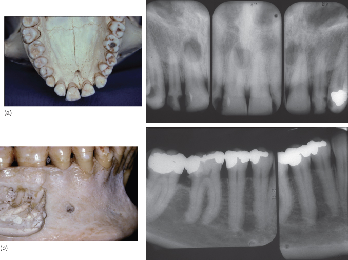 13 Radiographic Considerations during the Endodontic Treatment Pocket