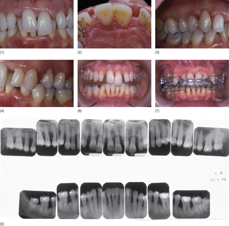 13 Interdisciplinary Collaboration Between Orthodontics and