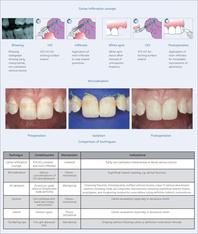 32 Microinvasive and minimally invasive techniques Pocket Dentistry