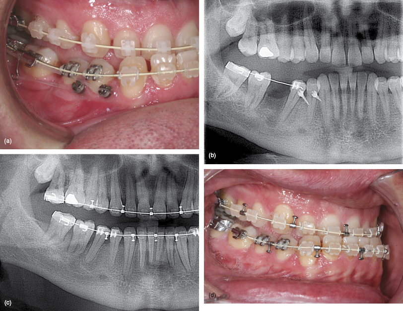 8 Molar Protraction Pocket Dentistry