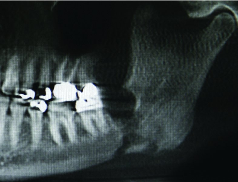 11 Osteomyelitis Pocket Dentistry