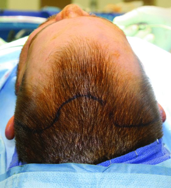 18 Frontal Sinus Fractures Pocket Dentistry