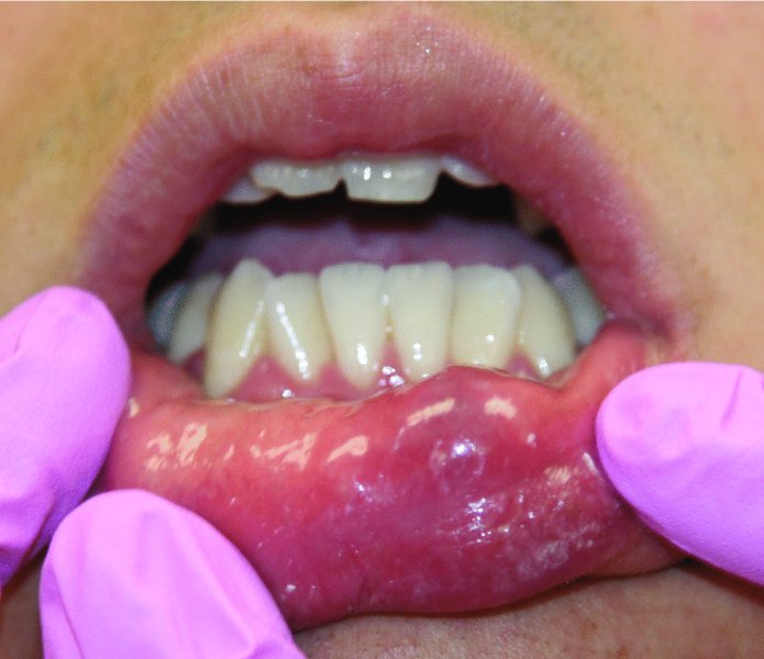 49 Salivary Gland Pathology Pocket Dentistry