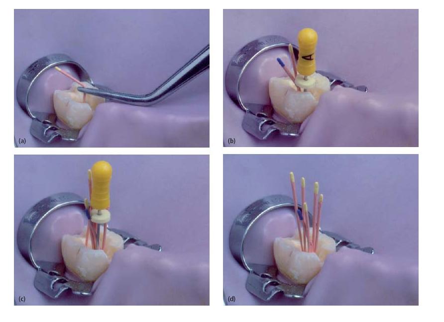 13 Root filling techniques Pocket Dentistry