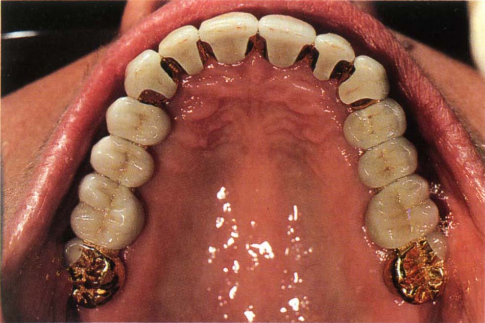 17 The Choice of Materials for Restoration Pocket Dentistry