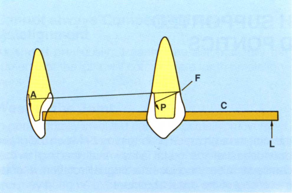 19 Posterior Cantilevered Pontics Pocket Dentistry