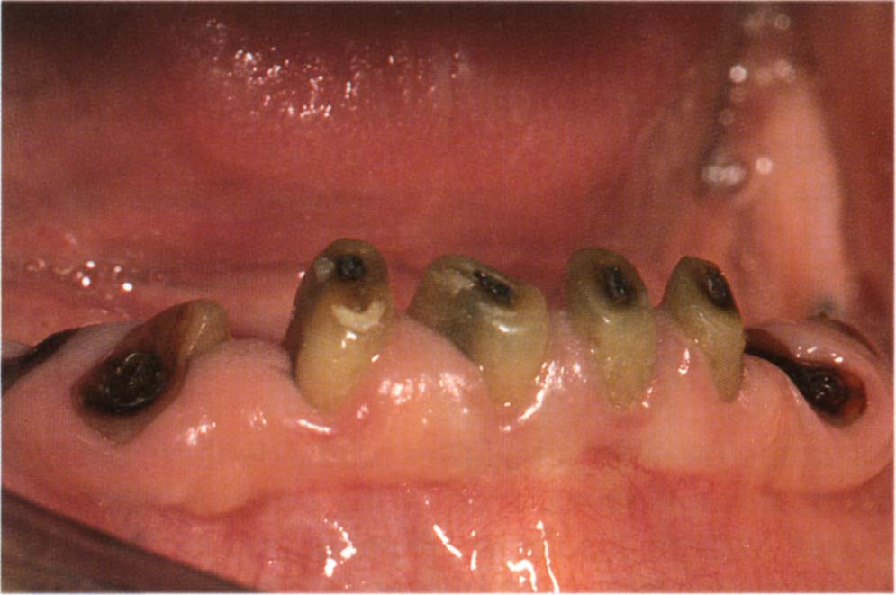 31 Overdentures Pocket Dentistry