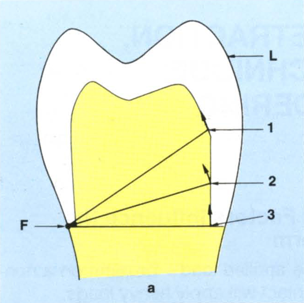 9 Tooth Preparation, Gingival Retraction, Hydrocolloid Impression