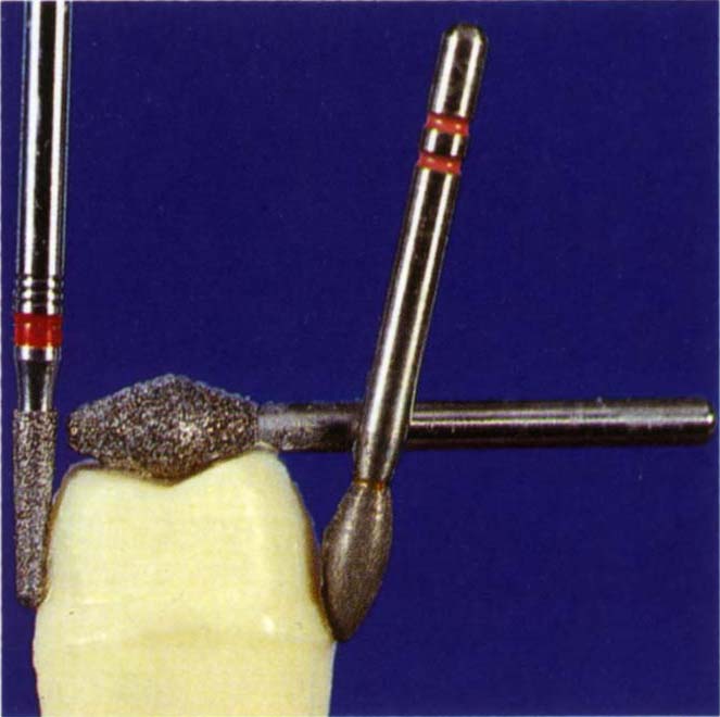 9 Tooth Preparation, Gingival Retraction, Hydrocolloid Impression