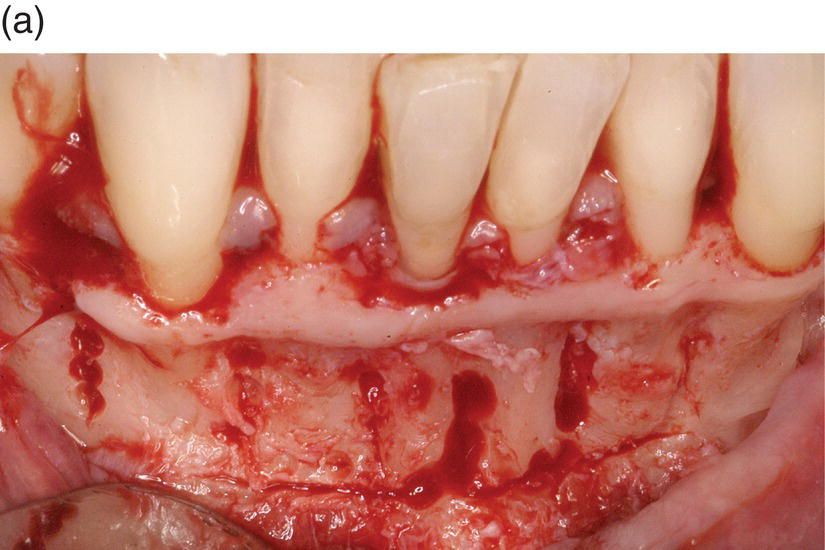 6 Orthodontically driven corticotomy Pocket Dentistry