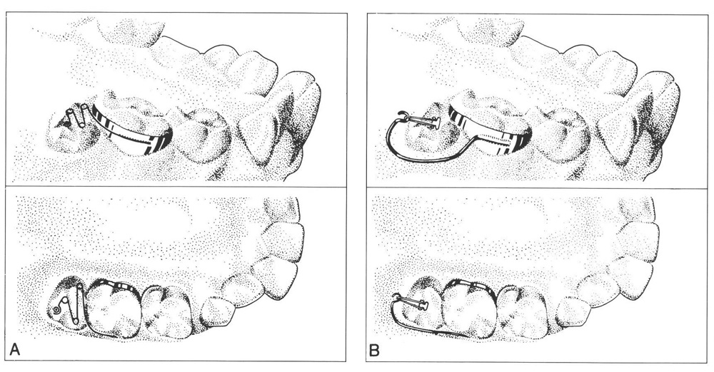 16 Problems in Eruption of First and Second Permanent Molars Pocket