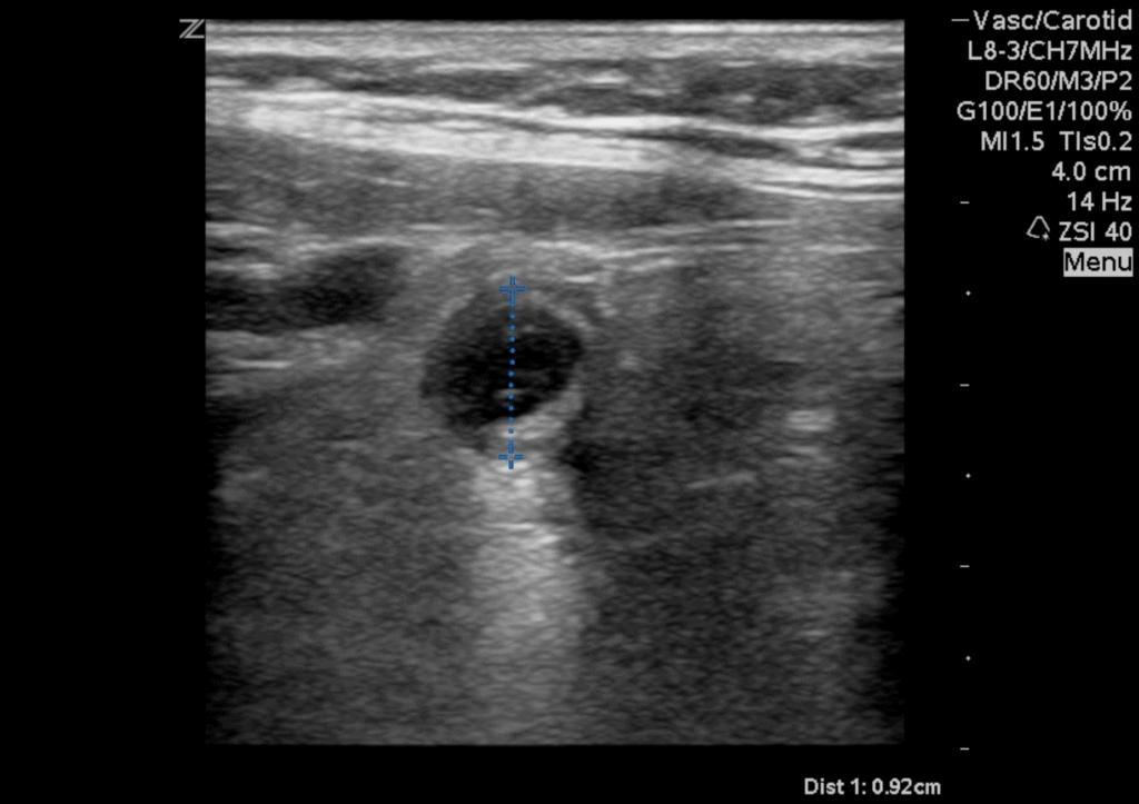 Abdominal Ultrasound Made Easy StepByStep Guide POCUS 101