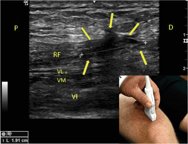 Ultrasound Imaging of Quadriceps Tendon in a Recreational Golfer