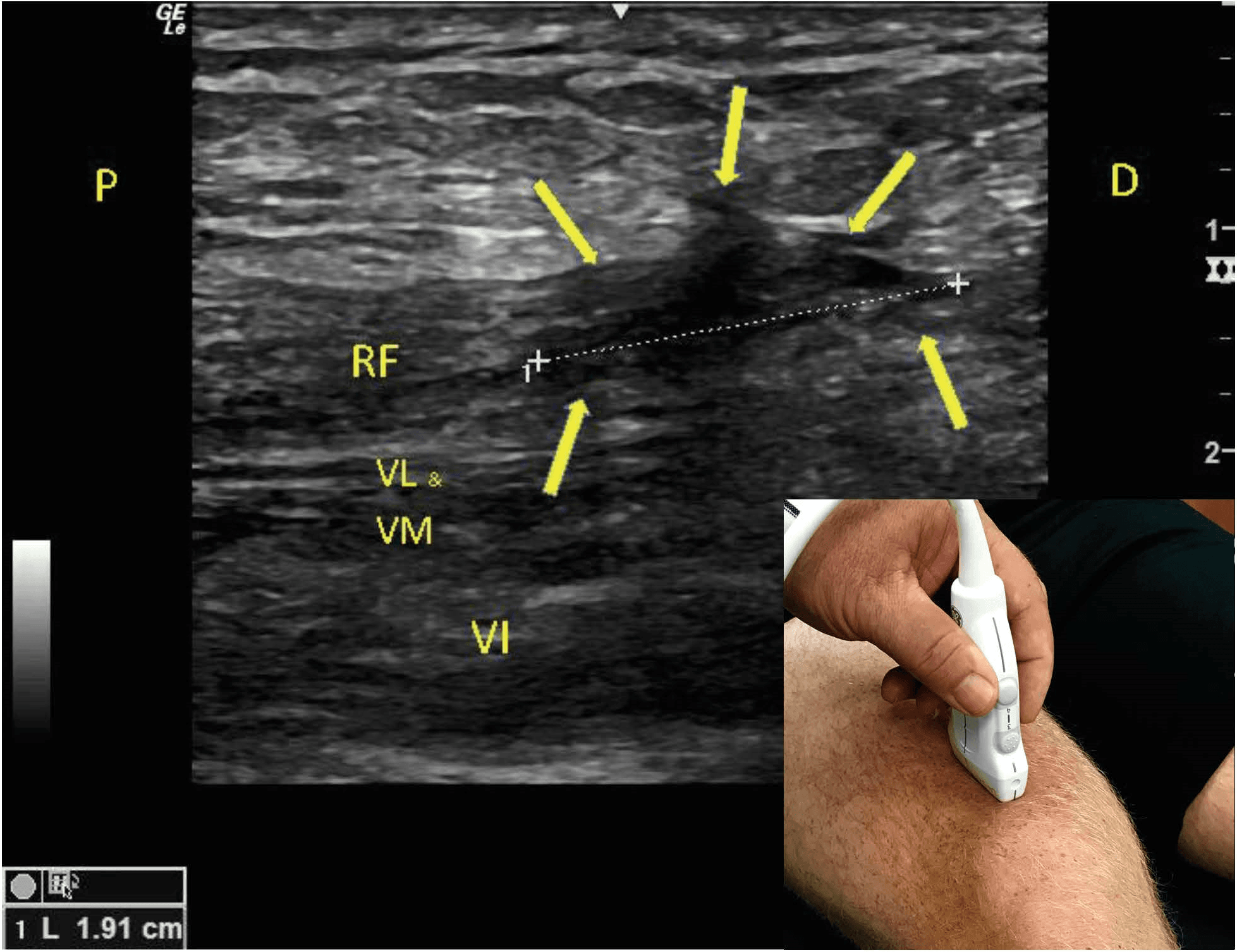 Quadriceps Tendon Ultrasound