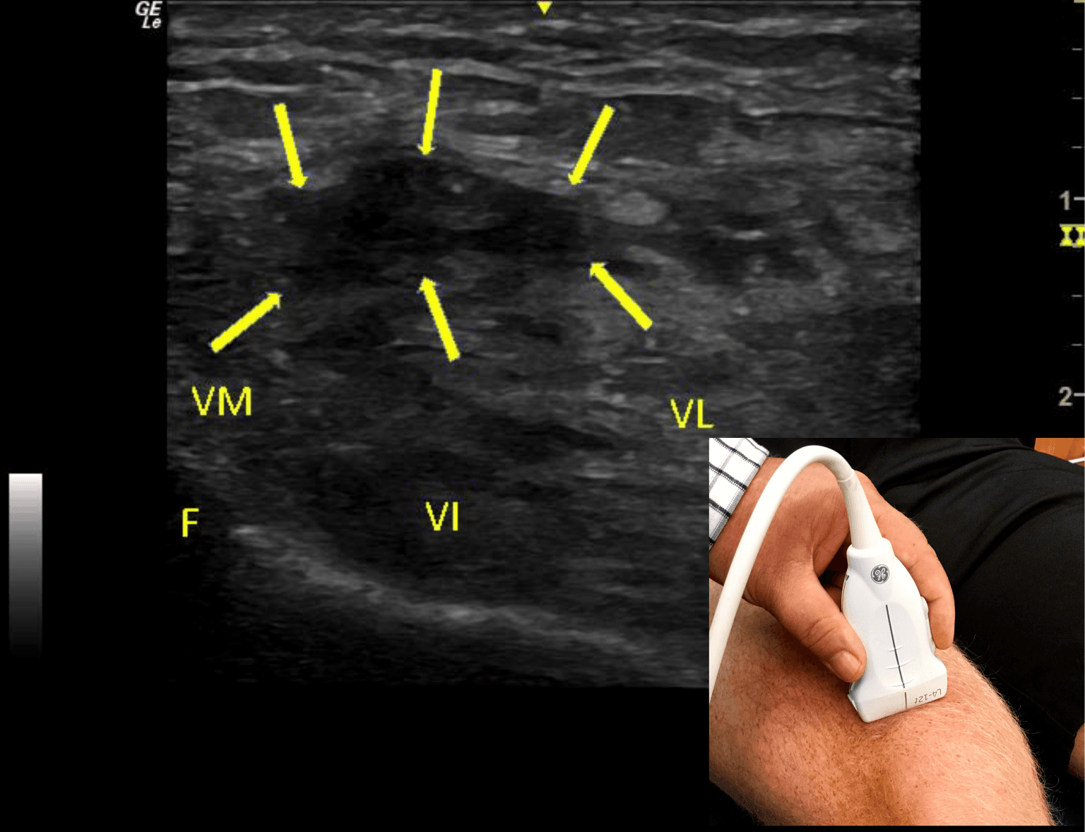 Ultrasound Imaging of Quadriceps Tendon in a Recreational Golfer