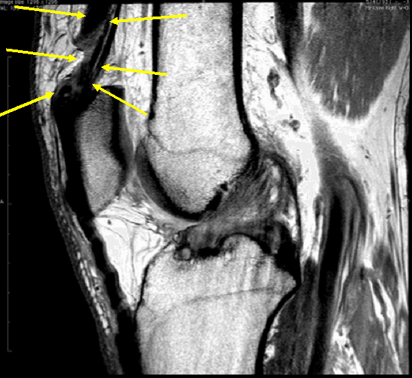 Quadriceps Tendon Ultrasound