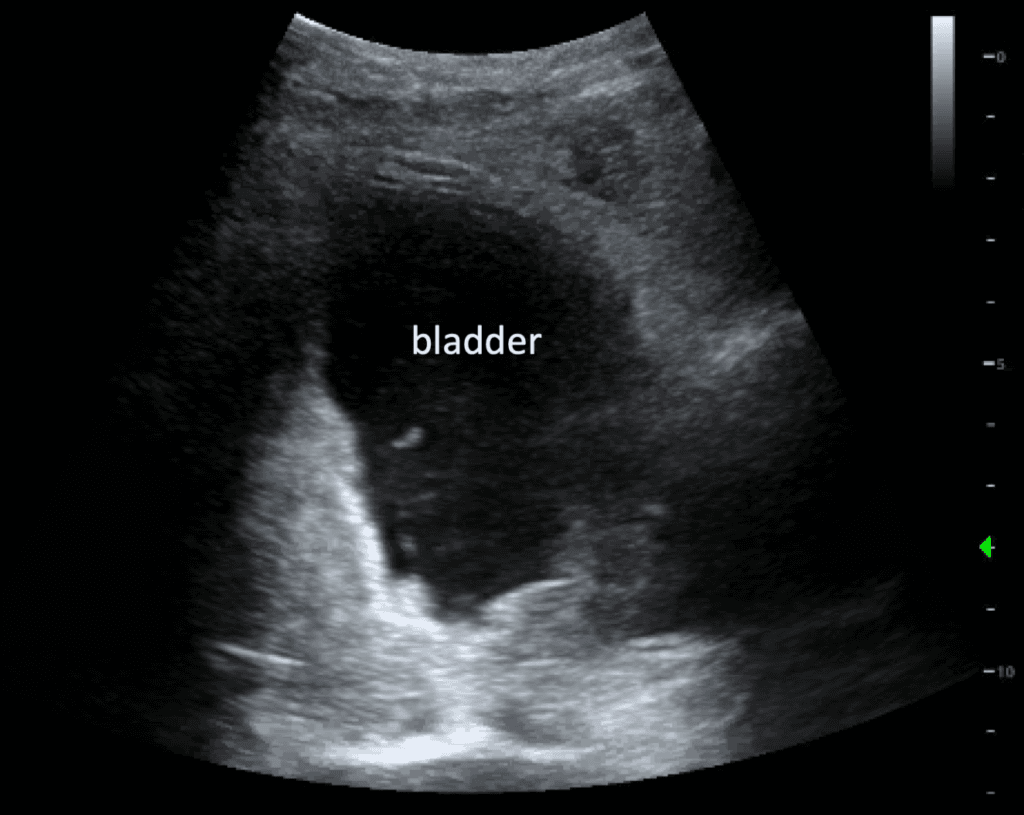 Delayed Iatrogenic Bladder Rupture Diagnosed by POCUS in the Emergency