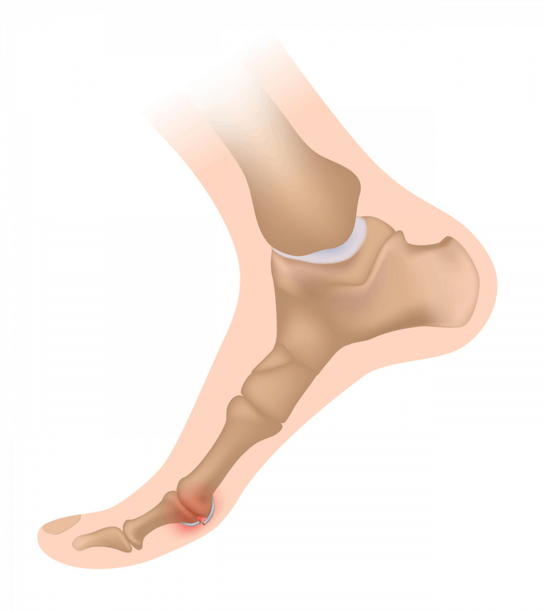 Douleur du gros orteil ? Voici les causes et traitements possibles