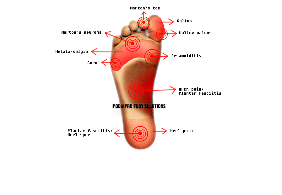 Foot pain Podiapro Custom insoles and footwear for pain relief