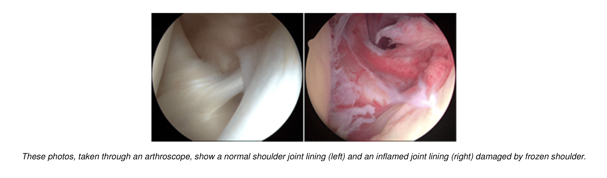 A Review of Current Frozen Shoulder Treatment Options with Lewis Craig