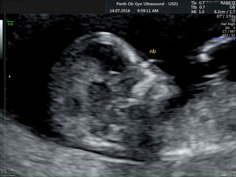 First Trimester Screening Gallery POGU
