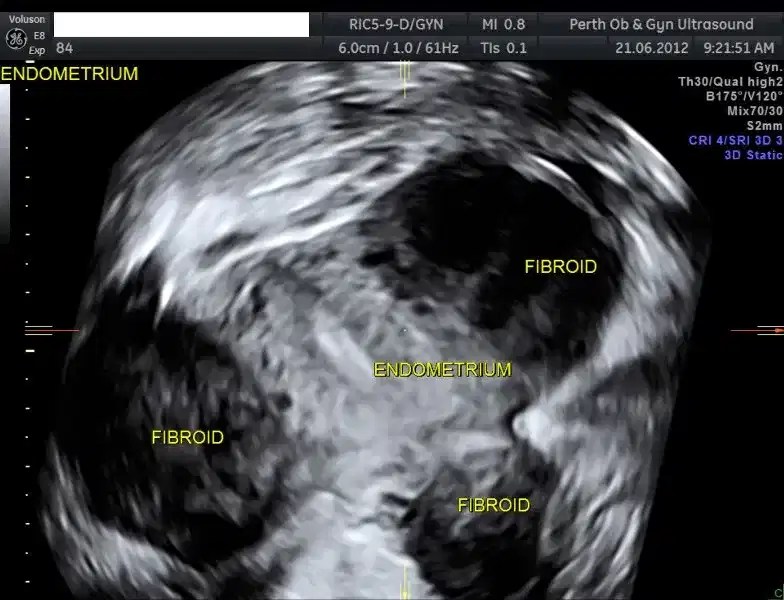 Pelvic Ultrasound POGU