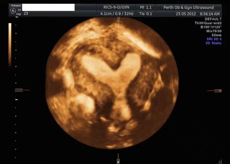 Pelvic Ultrasound POGU