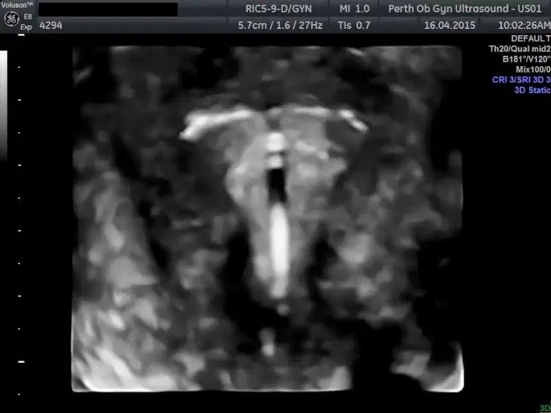 Pelvic Ultrasound POGU